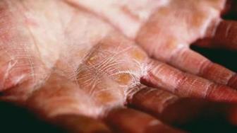 What Is Eczema? Symptoms, Causes, and Preventions